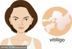 郑州华夏中医:去除皮肤白点法